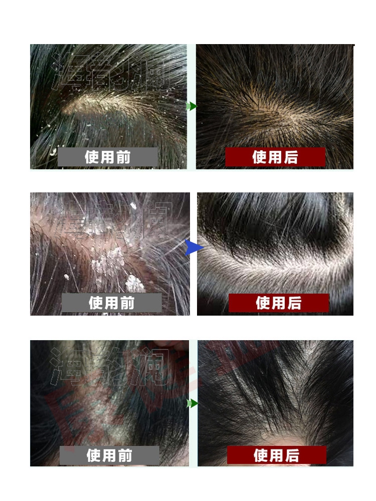 大块头皮屑神器去头屑克星除头螨去屑止痒洗水修研洗液100ml