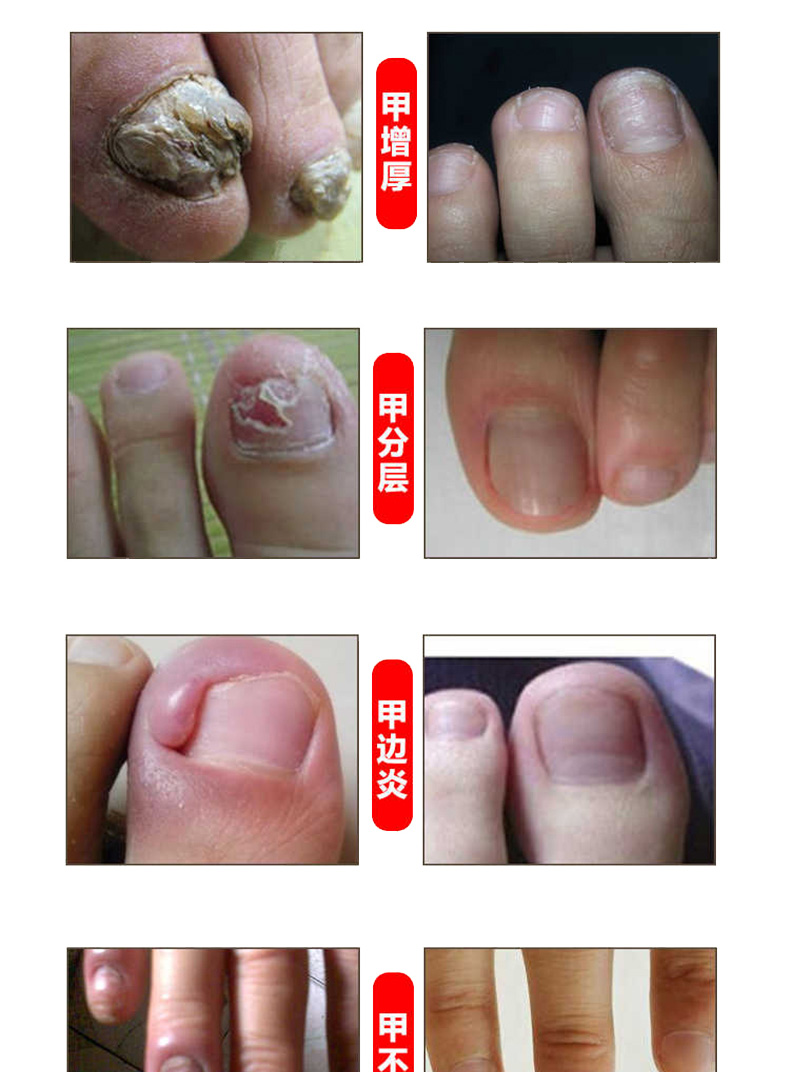 6天高浓缩型灰指甲专用药灰指甲药膏齐峰堂灰甲清非亮甲棣华灰甲清