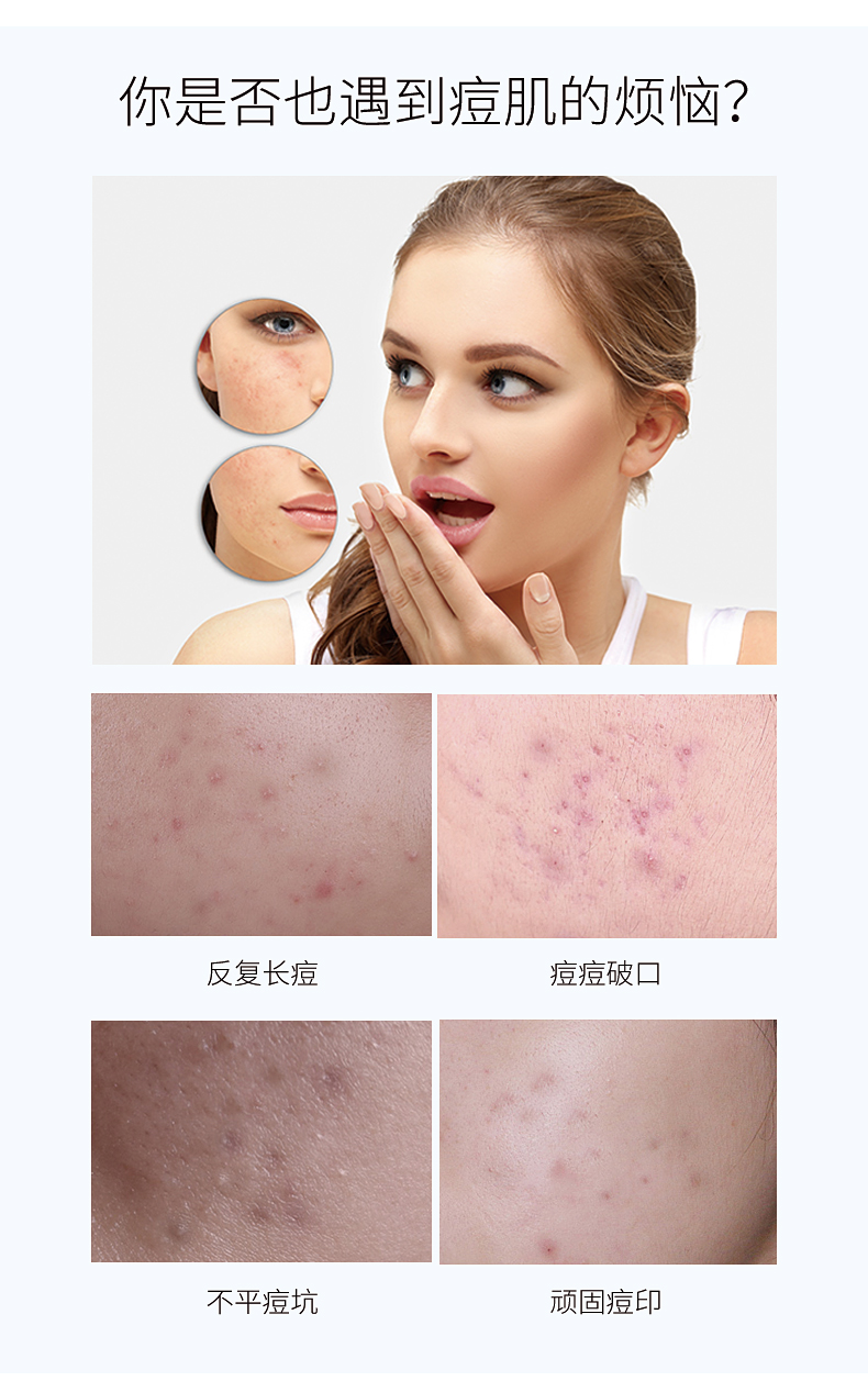 民阳堂祛痘膏快速去痘神器青春痘印男女士去闭口粉刺面部