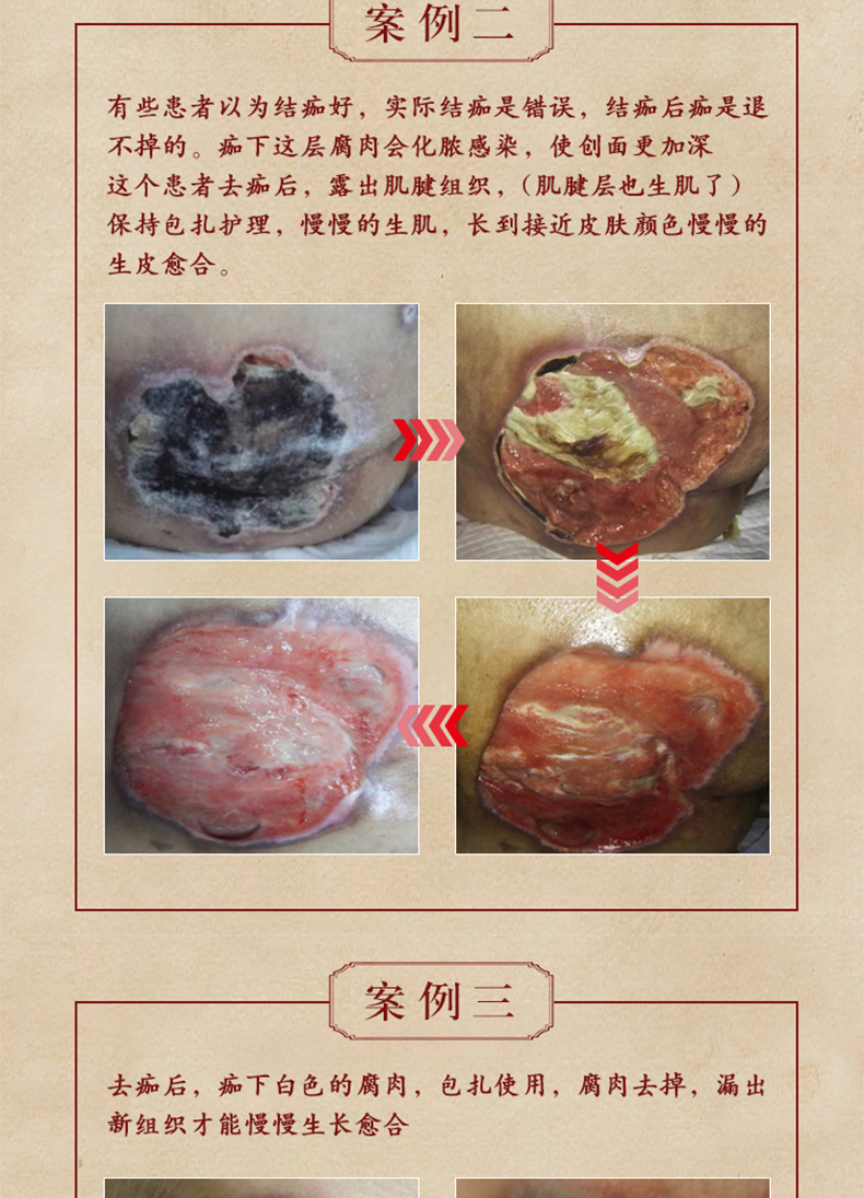 人伤口愈合祛压疮膏皮肤溃烂老烂腿护理膏玉红膏佰沐康褥疮膏20g盒