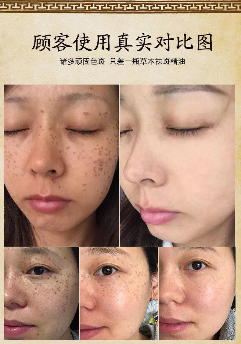 去黑点神器祛斑祛痣祛痘印精油祛斑无痕无痛去黑色素男女一瓶体验装