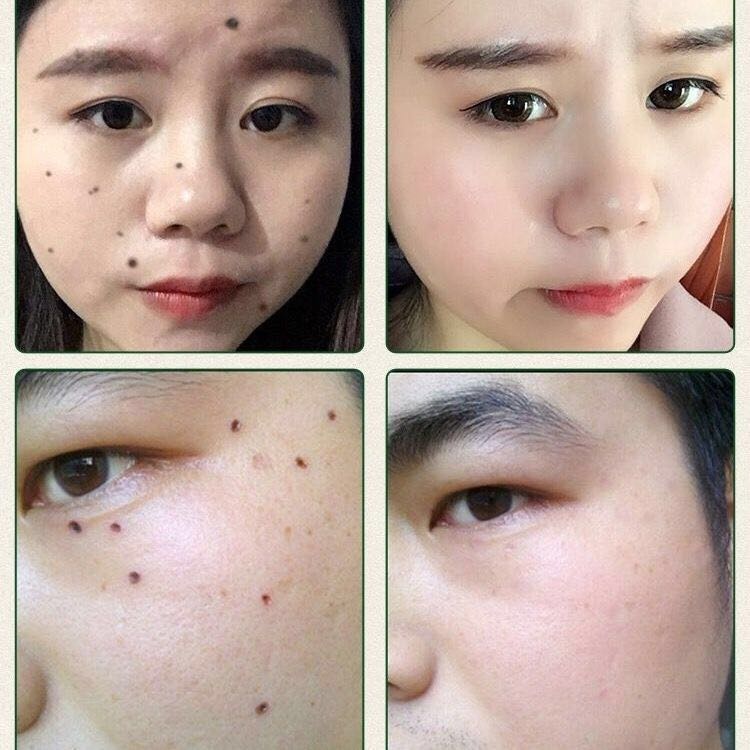 点痣药水点斑药水脸部去痣祛斑水点黑痣肉痣祛痣膏雀斑水老年斑