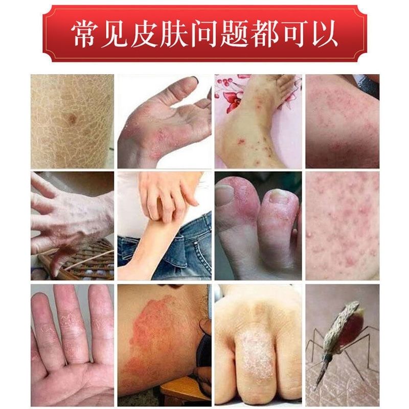 千年奇草乳膏江西越洋千年奇草皮肤外用抑菌大腿内侧瘙痒