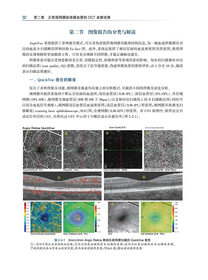 oct血管成像图谱影像分析与解读三十余种临床眼科常见疾病的octa表现