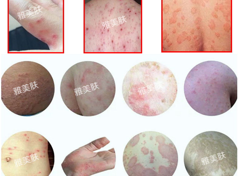 雅美肤西域湿毒清软膏皮肤瘙痒外用止痒膏皮炎湿疹胶囊苗药去牛皮藓