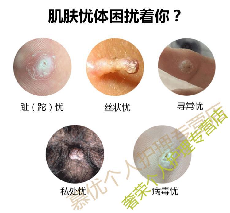 官方专营本平灵液霜疣瘊平hpv去疣老茧除跖疣瘊子肉刺寻常疣趾疣平疣
