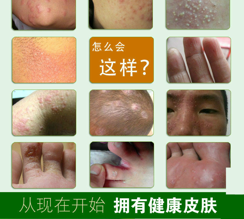 克癣王喷剂癣痒灵癣根净体癣药水银屑病牛皮癣药膏股癣大腿内侧瘙痒