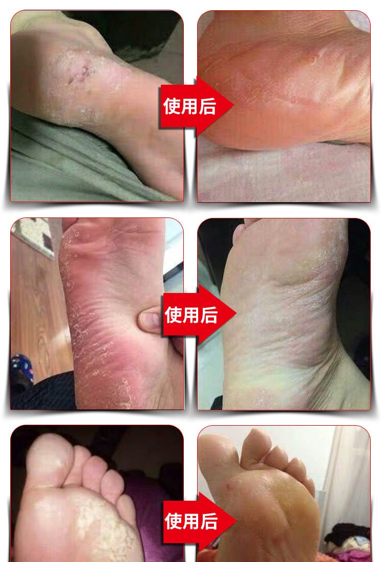 去脚气脚臭脚痒脚气治疗脚气膏脱皮除脚气套装除脚气喷剂60ml 【1瓶】