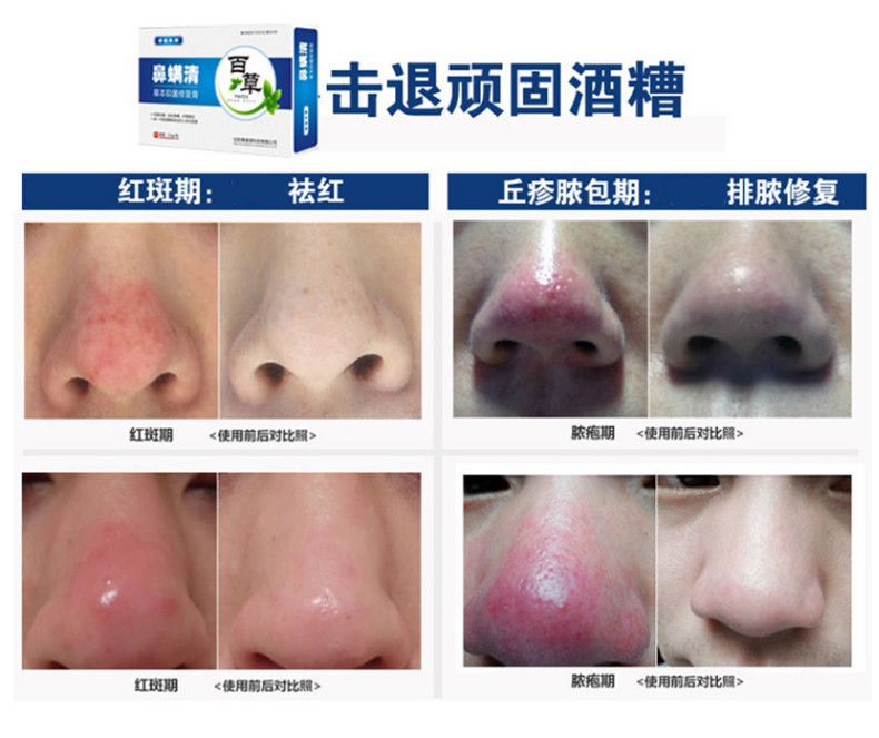 伊白云飞美肤皂 酒糟鼻 修复去莓鼻酒鼻虫红鼻子鼻