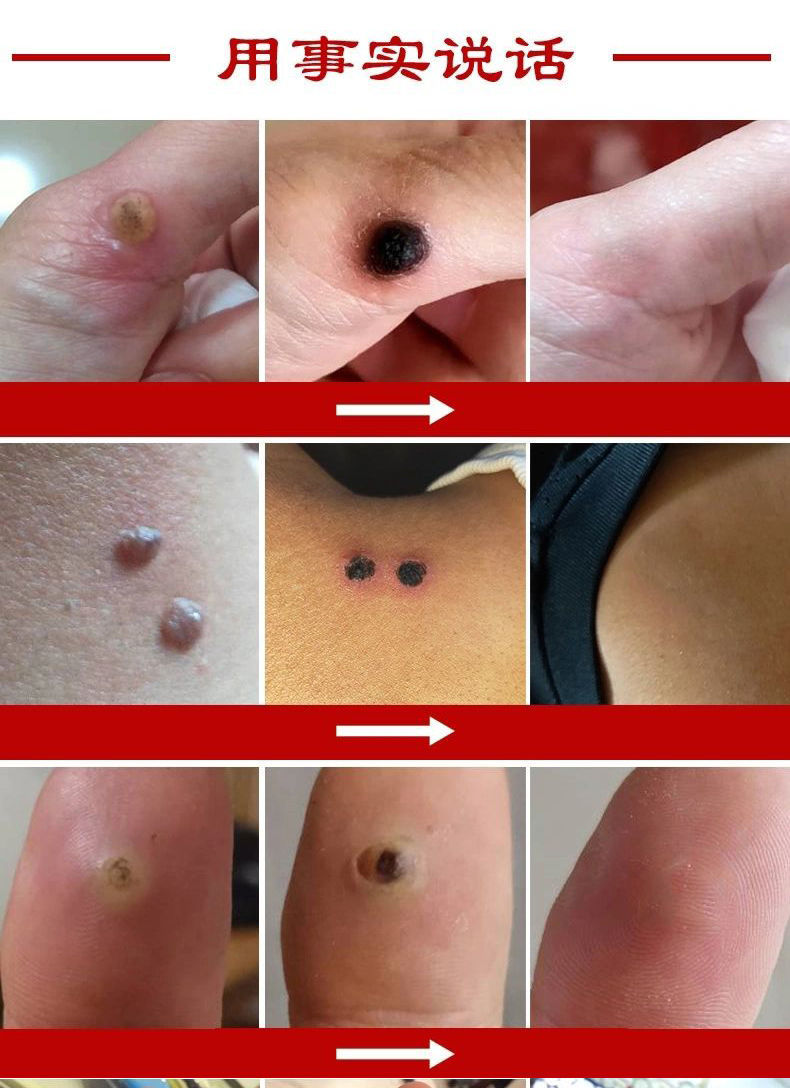 《1盒【米粒大小】去鸡疣10-15个 瘊疣偏方去身体