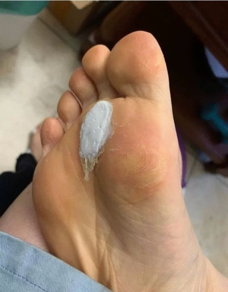 茧艺去老茧除脚茧软化剂关节茧手茧清茧灵脚底去茧子死皮脚垫角质茧艺