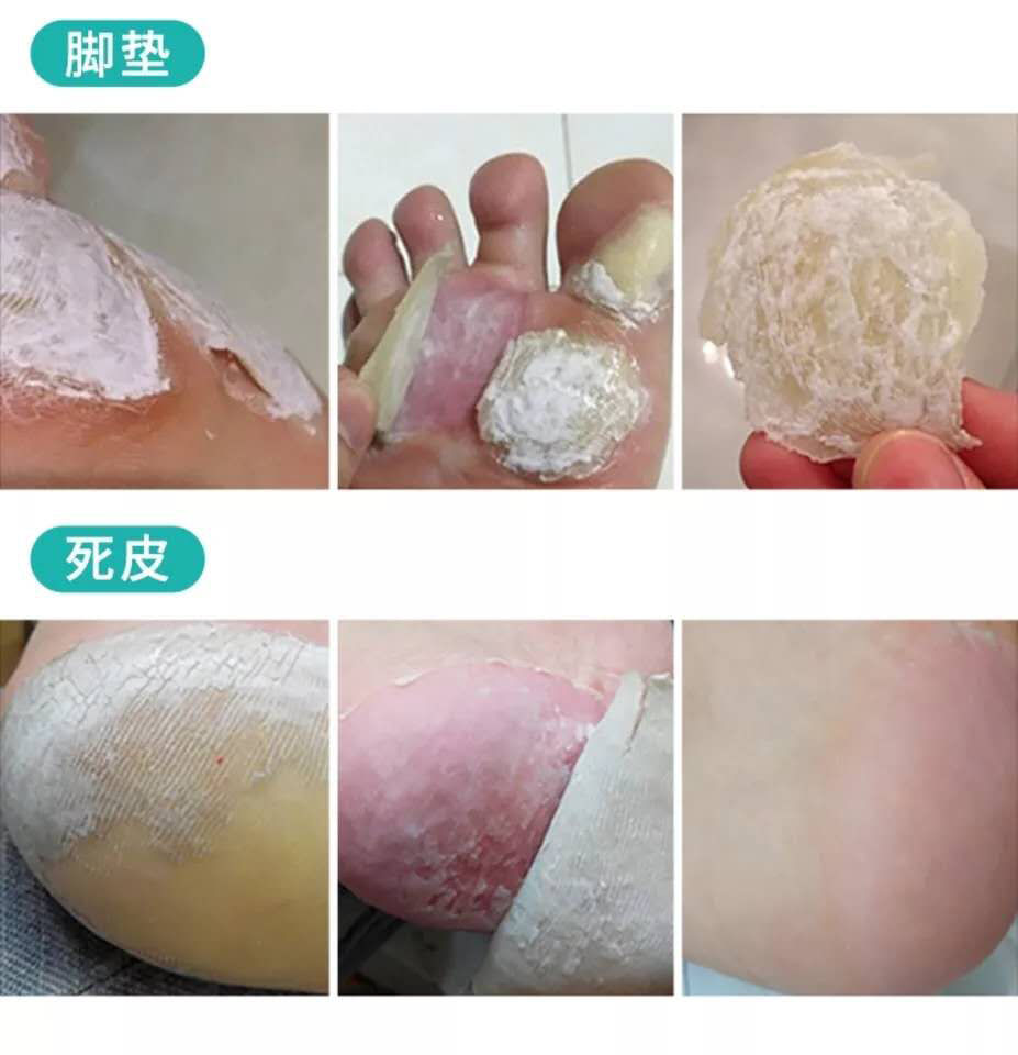 老茧去除脚茧鸡眼膏贴特效肉刺脚疔鸡茧消滴茧王清茧灵一盒10毫升