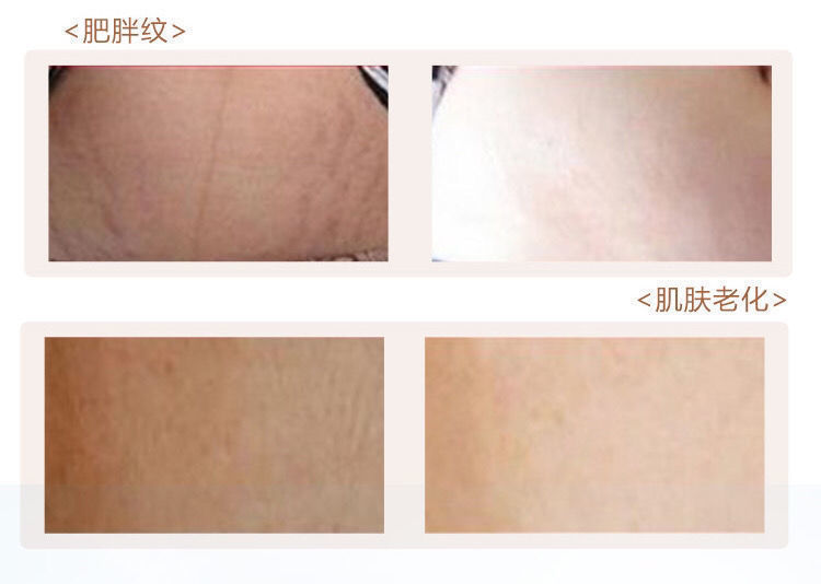 《去妊娠纹产后修护霜孕妇专用预防祛肥胖纹生长纹消除紧致疤痕克星