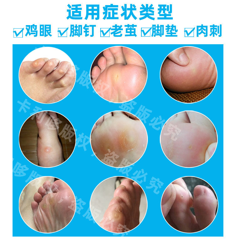 鸡眼贴鸡眼膏消茧灵去除老茧鸡眼脚垫肉刺猴脚钉脚茧关节茧血刺泡6片