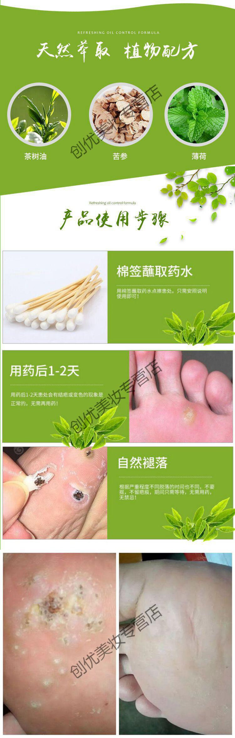 去鱼鳞痣膏贴去除肉刺手足部猴子脚钉膏贴跖尤去除鱼修子【价格 图片