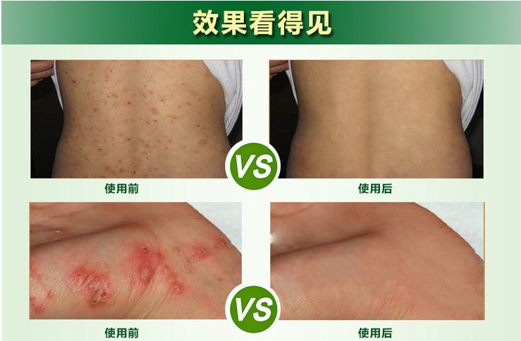 虱宁康虱乐宁成人喷剂虱尔乐头虱子药一扫光儿童玉锦