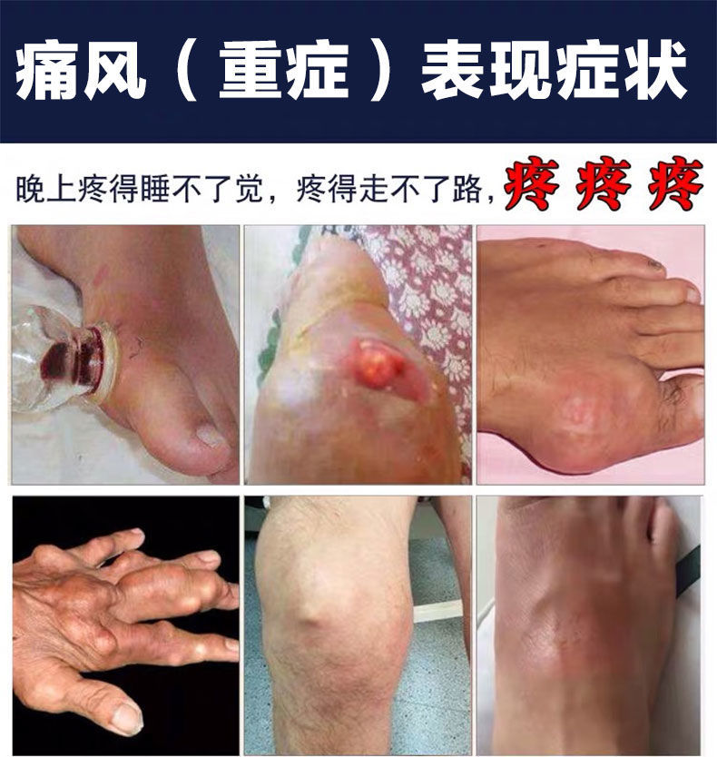 誉芙美痛风贴膏关节肿胀变形酸胀1盒8贴